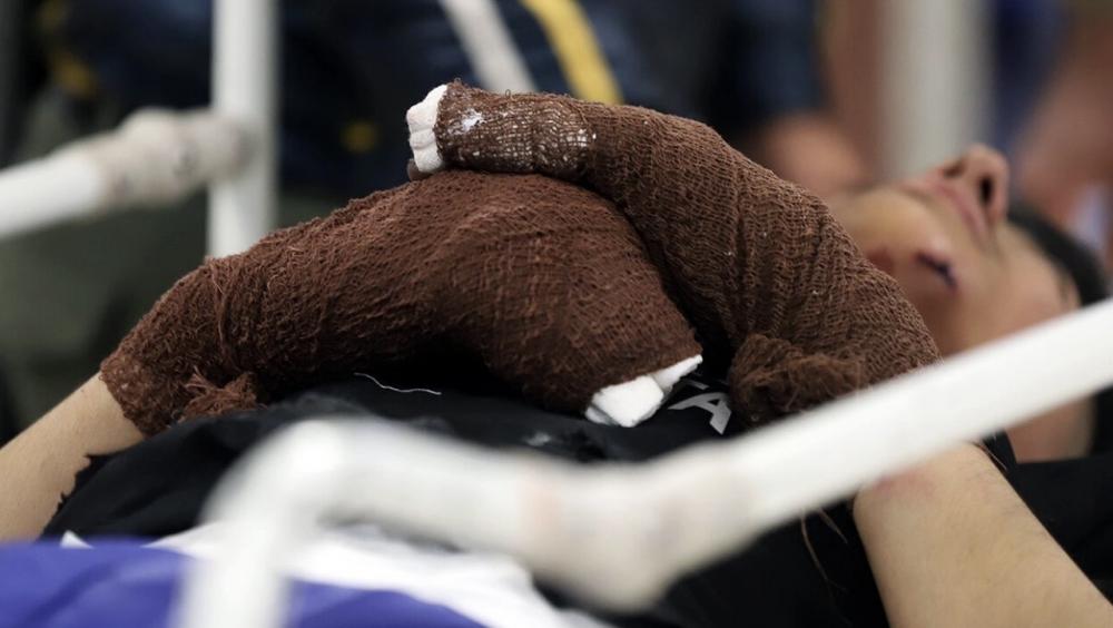 میزان سوختگی در ایران ۸ برابر میانگین جهانی