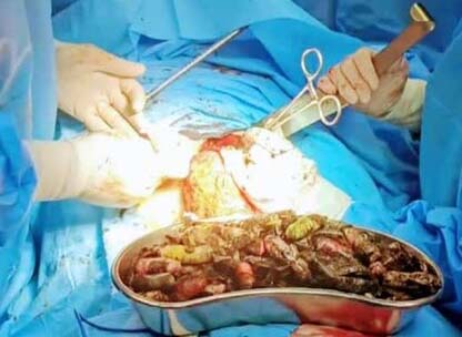 خروج ۹۰ بسته مواد مخدر از معده و روده یک بیمار در کرج