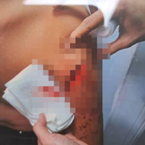 چاقو کشی در مدرسه غیر انتفاعی خمام/ مجروح شدن دانش‌ آموز ۱۴ ساله با چاقوی همکلاسی!