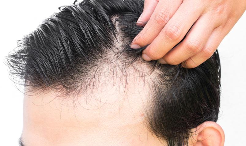 استرس، عامل اصلی ریزش مو