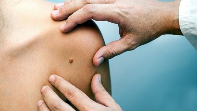  علائم سرطان پوست چیست؟ / از تغییر شکل خال تا خونریزی و خارش