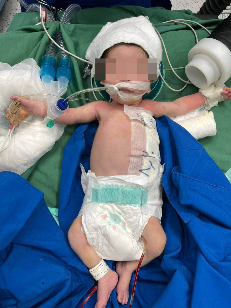 انجام موفقیت‌آمیز عمل جراحی کیست مادرزادی جدار شکم بر روی نوزاد ۱۱ روزه 