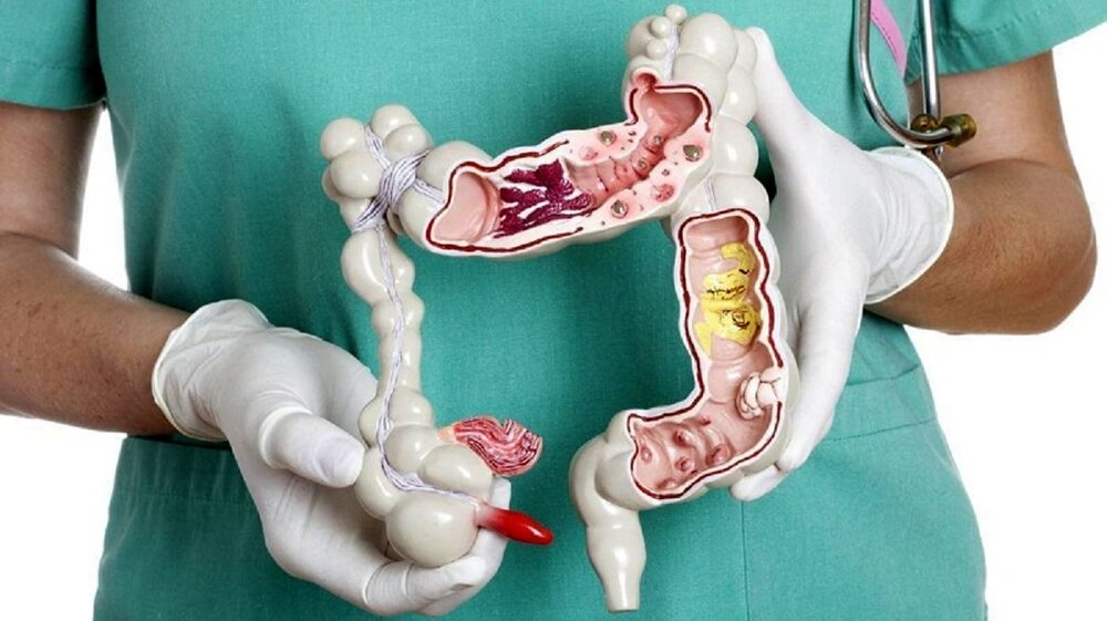 زنگ خطر سرطان‌ روده بزرگ در ایران؛ ضرورت اصلاح سبک زندگی و توسعه برنامه‌های غربالگری